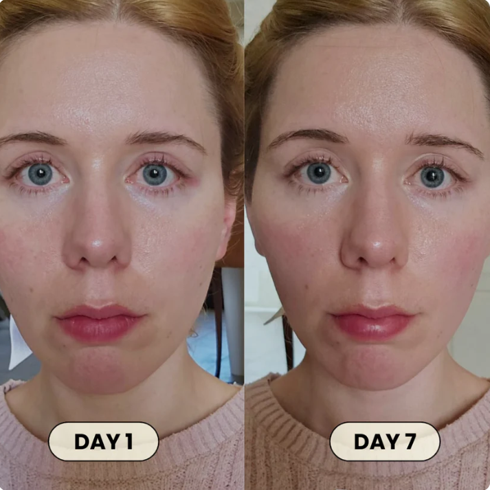 FémLift™ Face Shaper