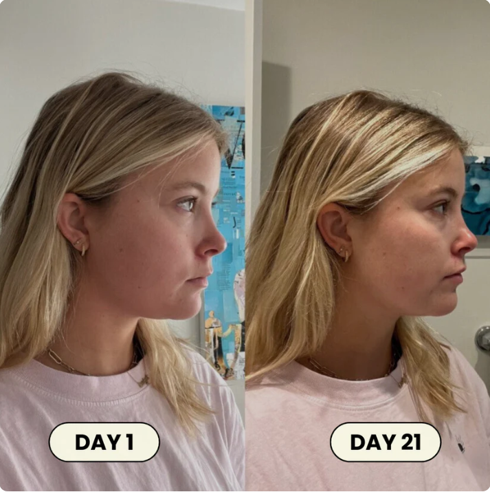FémLift™ Face Shaper