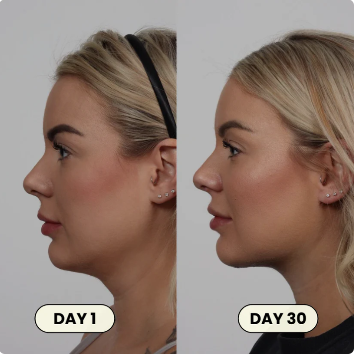 FémLift™ Face Shaper