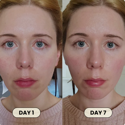 FémLift™ Face Shaper